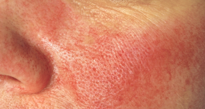 ROSACEA - WHAT YOU NEED TO KNOW - Arkana EN