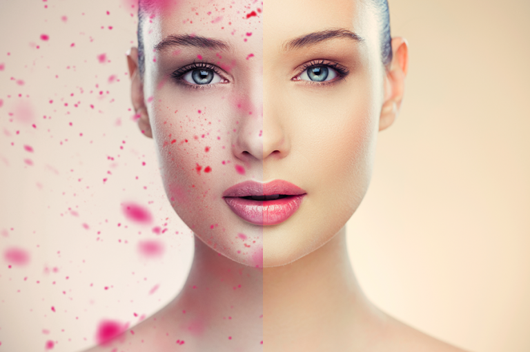 Flushed skin , pustules and papules may mean rosacea Arkana EN